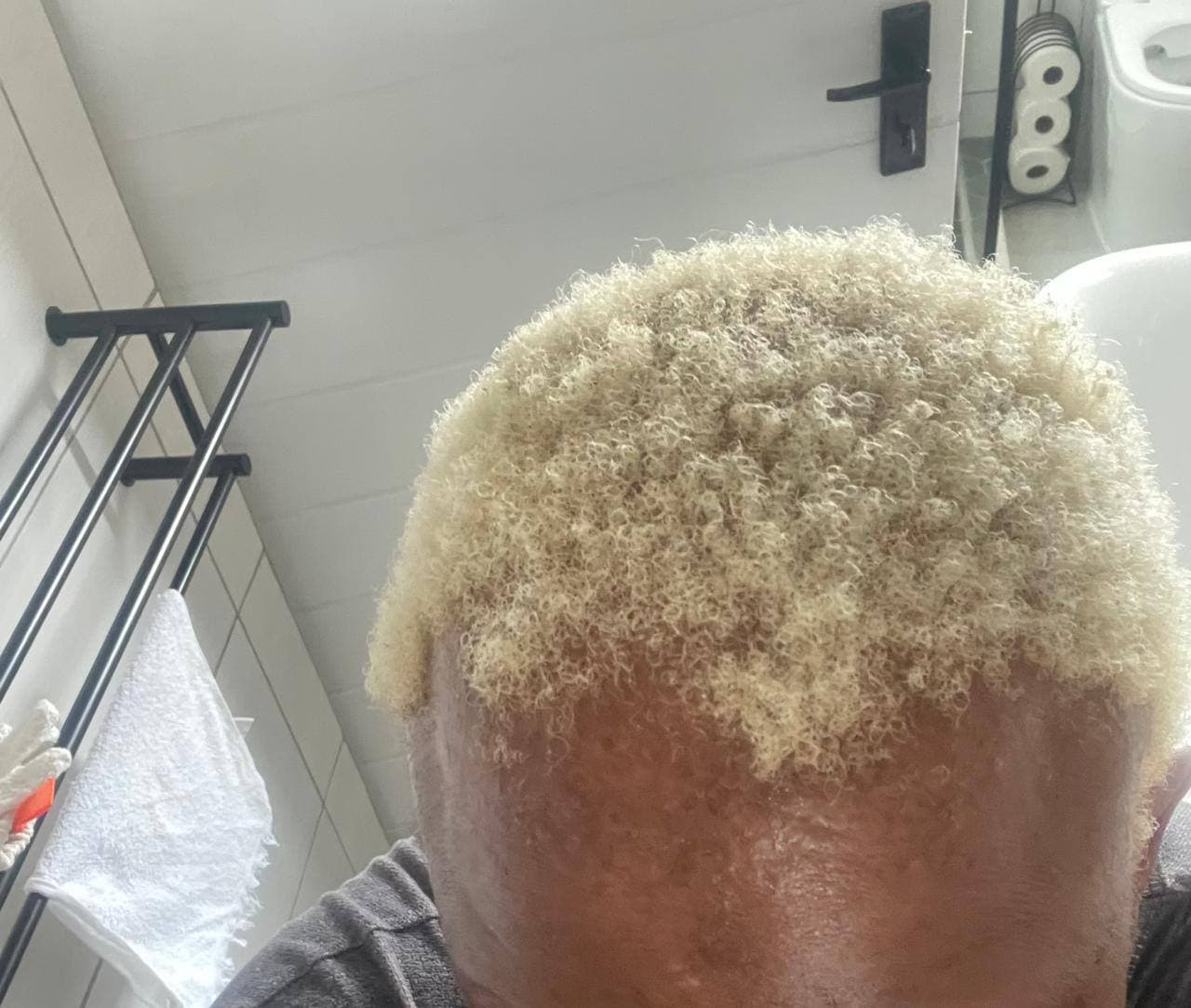 Struggling with alopecia? Don't stress; we've got you covered! 